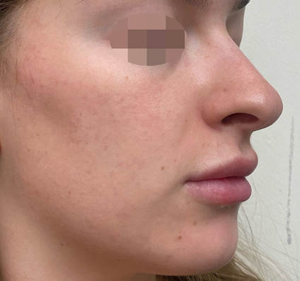 Pina Panchal MD acne scars_5 treatments after