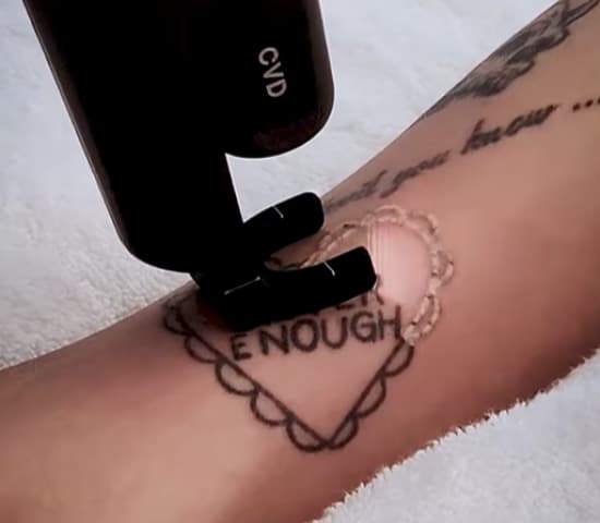 Como funciona a remoção de tatuagem a laser?