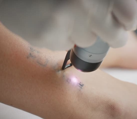 O processo de remoção de tatuagem funciona?