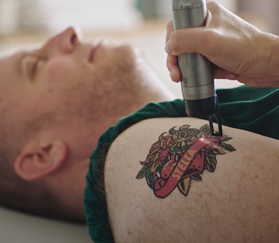 Como as tatuagens são removidas?